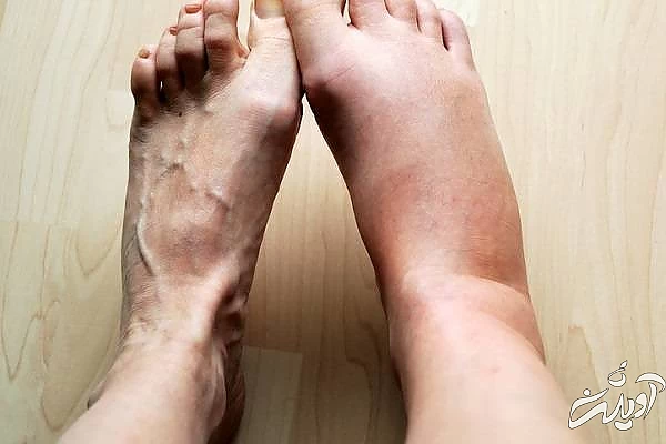 تورم ساق پا